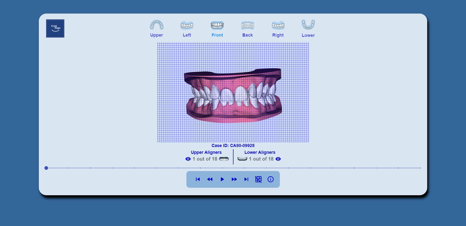 Measurement grid on, with the aligners shown over both arches.