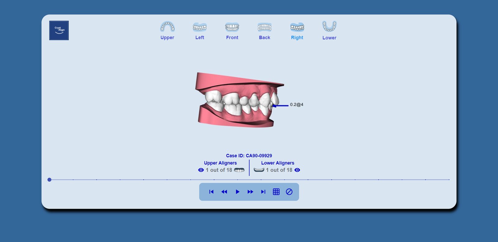 Interproximal reduction called on the plan: 0.2 mm, at stage 4.